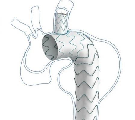 戈爾分支型胸主動脈覆膜血管內支架系統(tǒng)gore