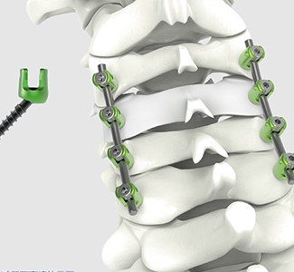 椎板固定板系統威高