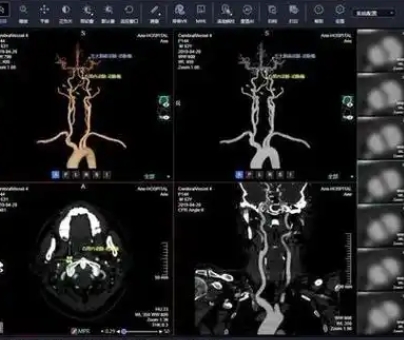 顱內動脈瘤ct造影圖像輔助檢測軟件