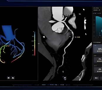 冠脈ct造影圖像血管狹窄輔助評估軟件