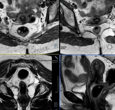 直腸mri醫學影像存儲傳輸與處理軟件
