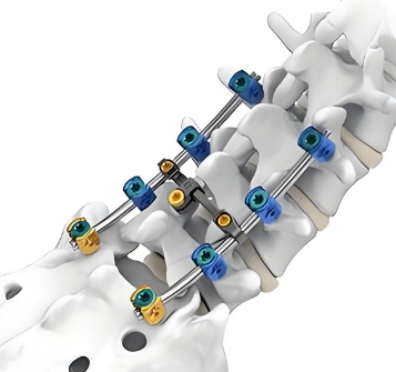  脊柱內固定系統組件