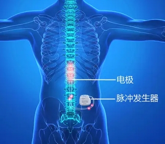  體外脊髓神經(jīng)刺激測試系統(tǒng)